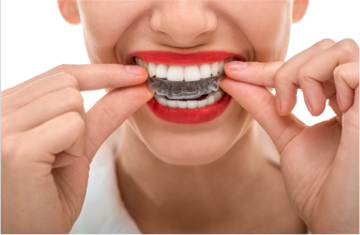 This is the image for the news article titled Invisalign Vs. Braces
