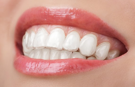 This is the image for the news article titled Best Time of Year To Get Invisalign