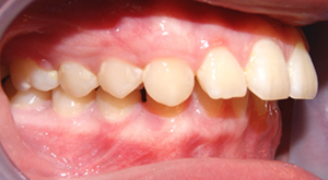 upper-front-teeth-protrusion